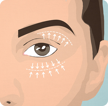 Blepharoplasty Image