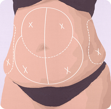 Abdominoplasty Image