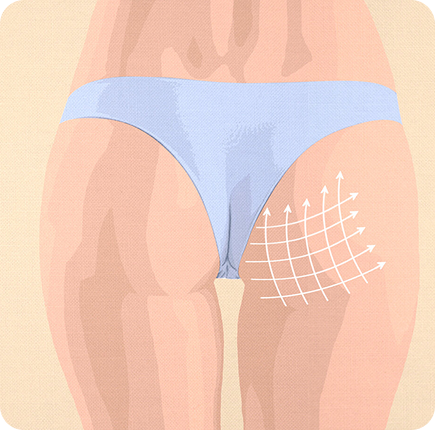 Gluteal Augmentation Image