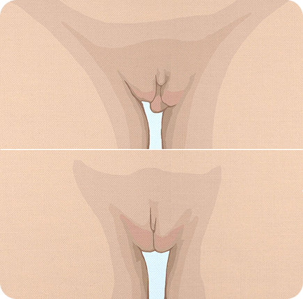 Labiaplasty Image